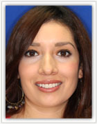 Thin Veneers 1 before