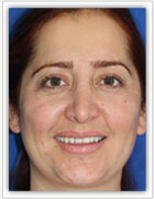 Thin Veneers 2 before