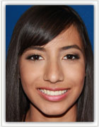 Veneers 2 after
