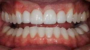 Crowns Case 1 after