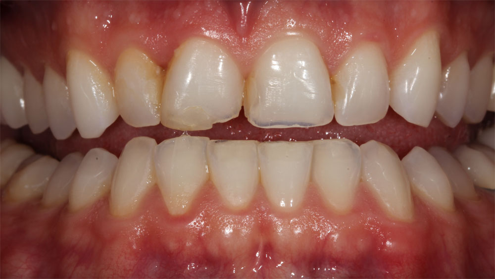Crowns Case 1 before