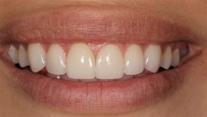 Thin Veneers Case 1 after