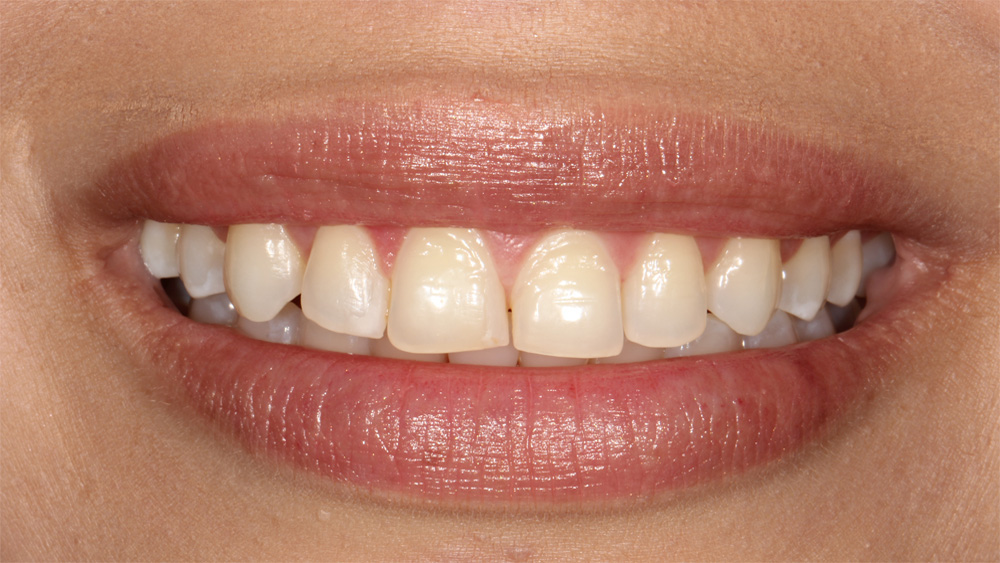Thin Veneers Case 1 before