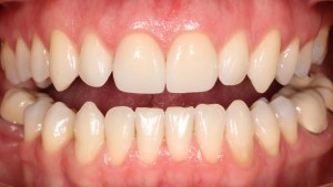 Thin Veneers Case 2 after