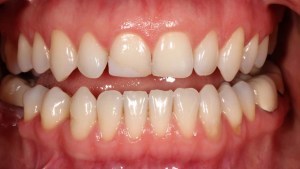 Thin Veneers Case 2 before
