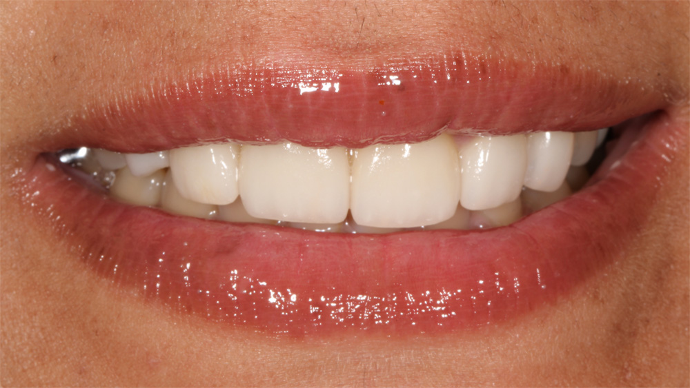 Veneers Case 1 after