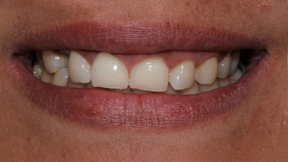 Veneers Case 1 before