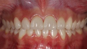 Veneers Case 3 after