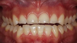 Veneers Case 3 before