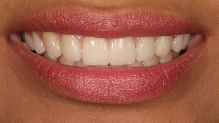 Veneers Case 4 after