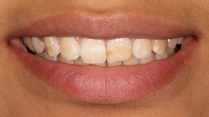 Veneers Case 4 before