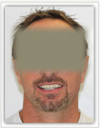 Lava Crowns Case 1 after