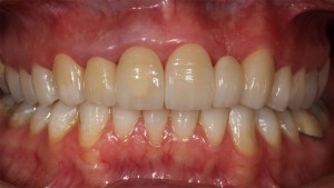 Lava Crowns Case 1 before