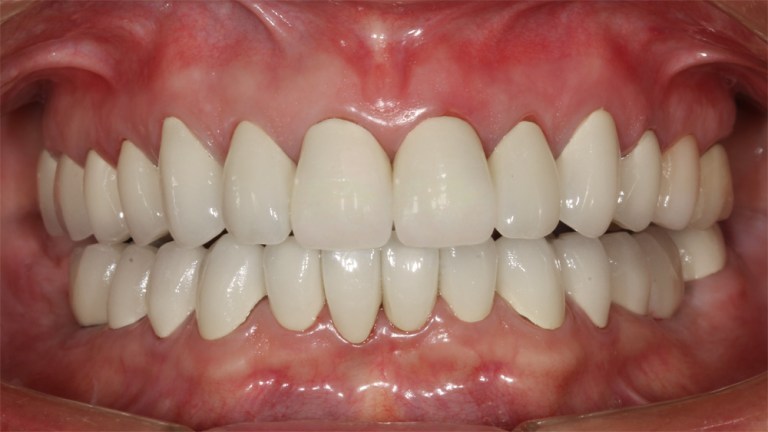 Porcelain Fullmounth Case 1 after