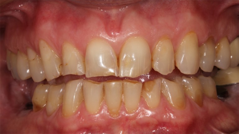 Porcelain Fullmounth Case 1 before