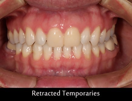 retracted-temporaries