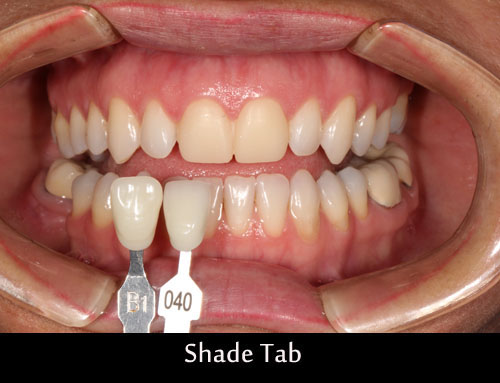 shade-tab