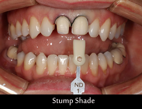 stump-shade