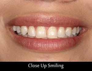wax-up-close-up-smiling