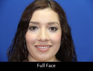 wax-up-full-face