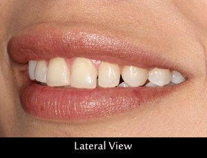wax-up-lateral-view