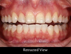 wax-up-retracted-view